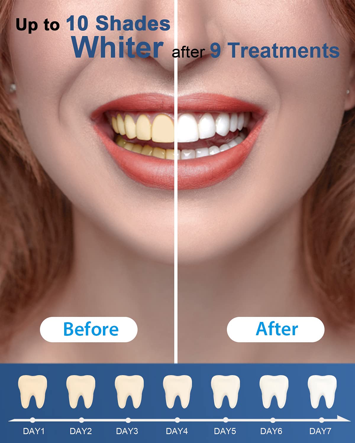 MySmile Teeth Whitening Gel Refills Pack 30+ Treatment Non-Sensitive Enamel Safe Tooth Whitener -10 Min Fast Whitening Teeth - Helps to Remove Stains from Coffee, Smoking, Wines(Excluding Tray Light) - Available at All In One Marketplace Canada