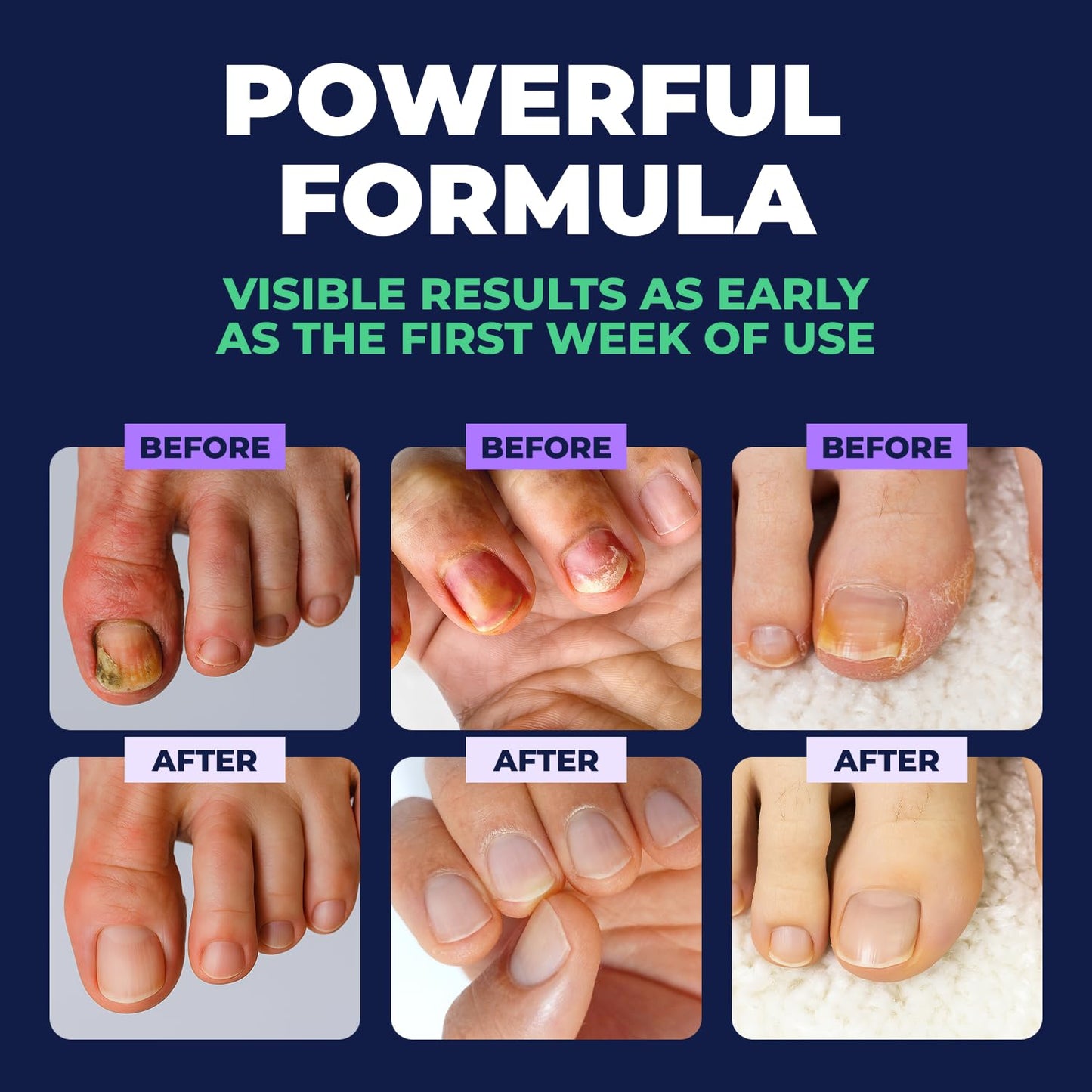 Orivelle Toenail Care Pen - Extra Strength Toe Nail Remedy - Professional Nail Solution for Fingernail with Tea Tree Oil (Pack of 4)