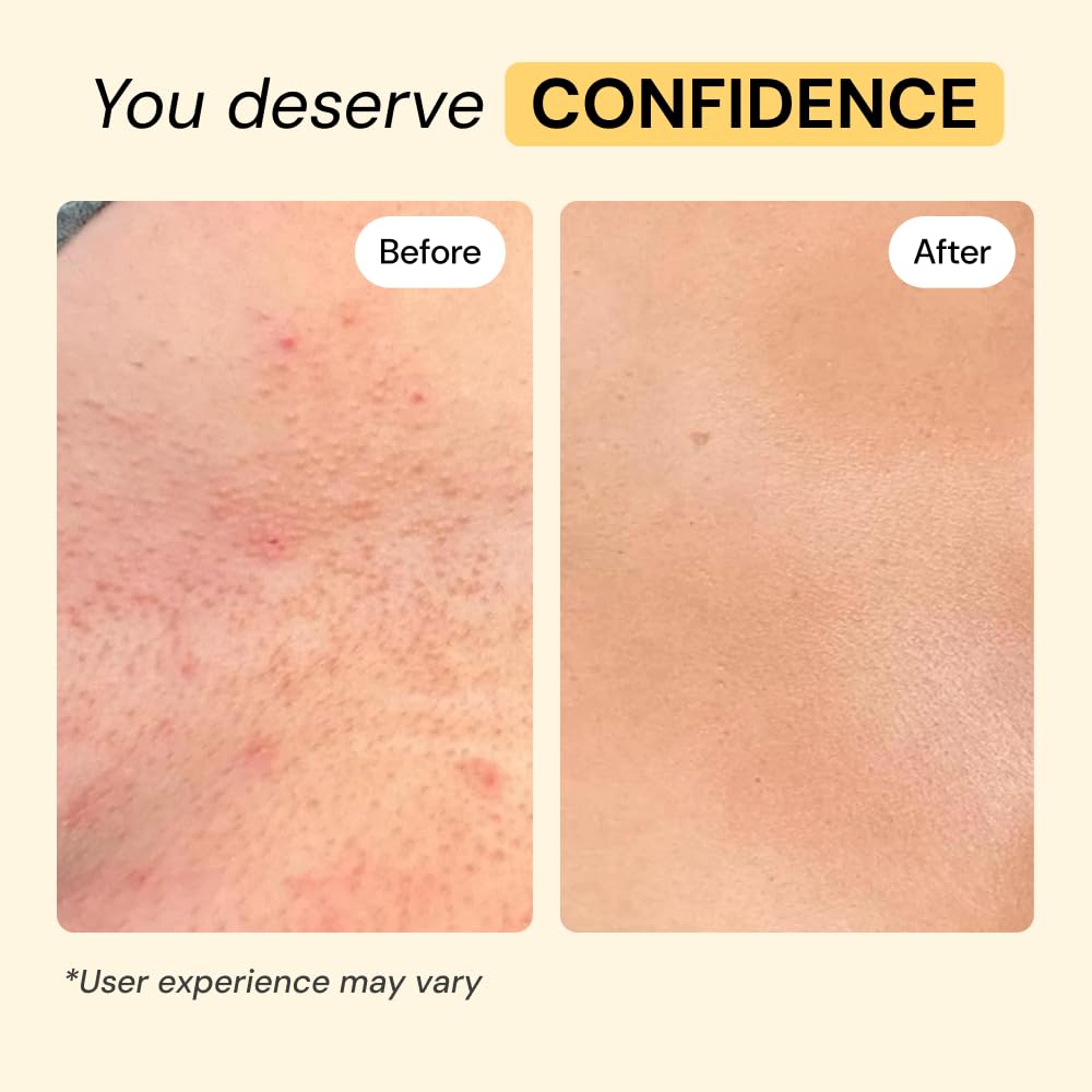 MyMagicHealer Universal Flare Care – Multi-Purpose Solution | Skin Flare-Ups - Hidradenitis Suppurativa, Folliculitis, Boils, Cysts | Anti-Chafing | Irritated Skin Relief w/Propolis & Egg Yolk 28 g - Available at All In One Marketplace Canada