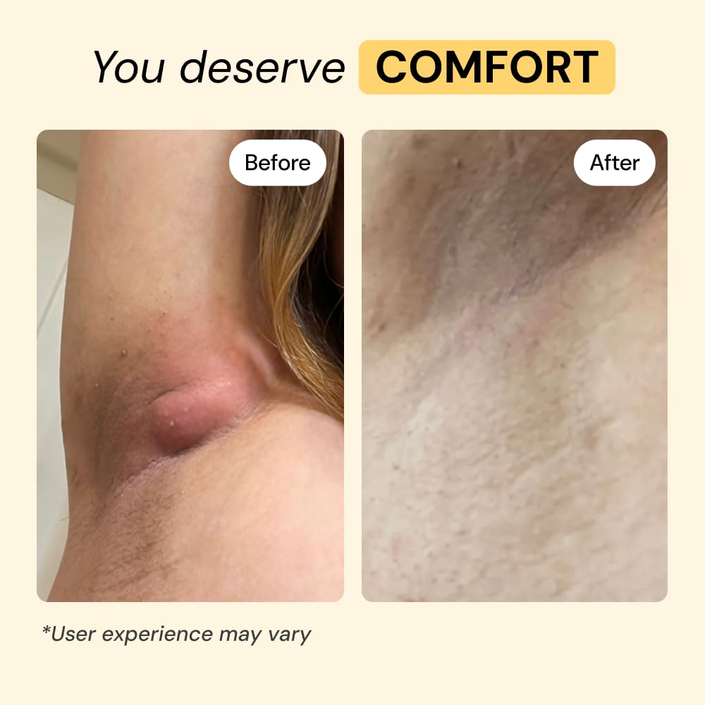 MyMagicHealer Universal Flare Care – Multi-Purpose Solution | Skin Flare-Ups - Hidradenitis Suppurativa, Folliculitis, Boils, Cysts | Anti-Chafing | Irritated Skin Relief w/Propolis & Egg Yolk 28 g - Available at All In One Marketplace Canada
