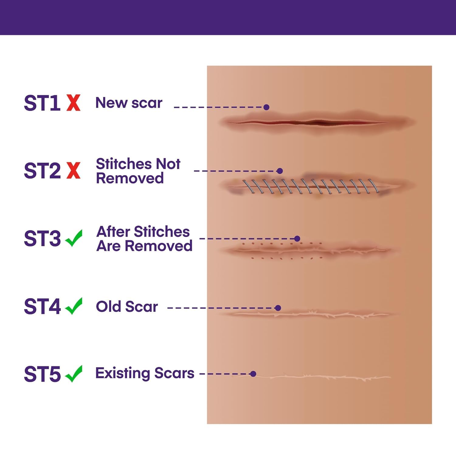 Silicone Scar Gel Scar Cream - SPF 30 Advanced Scar Gel for Old and New Scars - Available at All In One Marketplace Canada