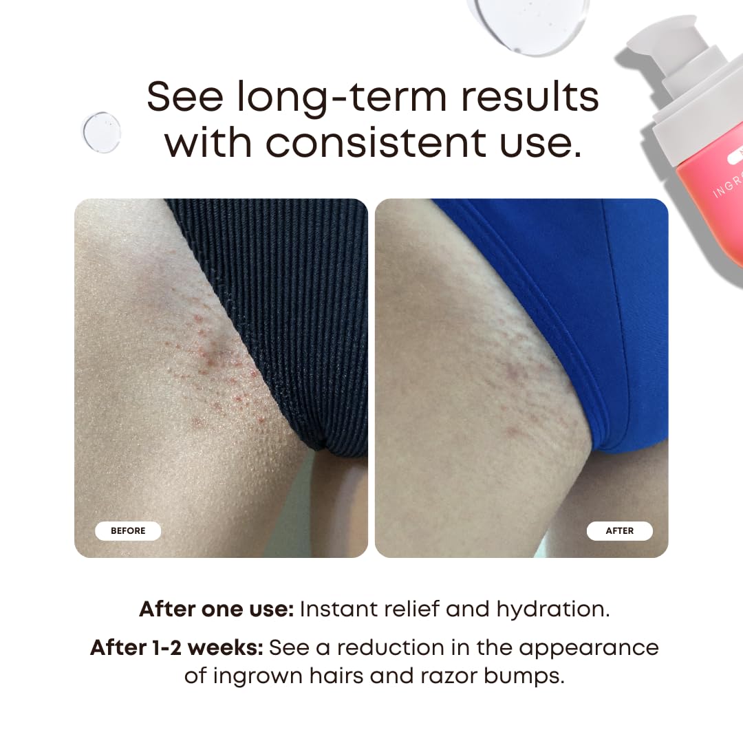 Bushbalm Ingrown Hair 2 Step Routine - Moisturize and Soothe - Ingrown Hair Oil (30 ml), Exfoliating Scrub (236 ml) - Watermelon Sugar - Valued at $49 - Available at All In One Marketplace Canada