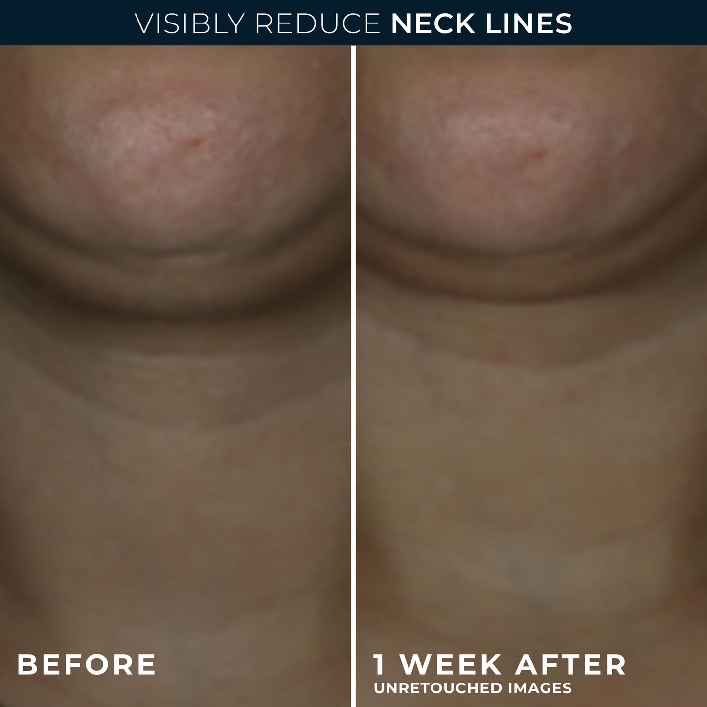 RoC Derm Correxion® Neck Cream with Hyaluronic Acid and Advanced Retinol to visibly Tighten & Lift Horizontal Neck Lines, Facial Moisturiser to Contour Face, Neck and Jawline, 50ML RoC