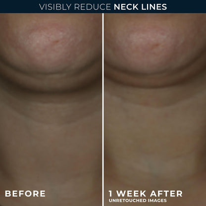 RoC Derm Correxion® Neck Cream with Hyaluronic Acid and Advanced Retinol to visibly Tighten & Lift Horizontal Neck Lines, Facial Moisturiser to Contour Face, Neck and Jawline, 50ML RoC