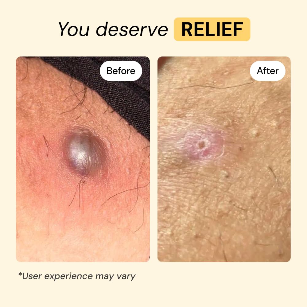 MyMagicHealer Universal Flare Care – Multi-Purpose Solution | Skin Flare-Ups - Hidradenitis Suppurativa, Folliculitis, Boils, Cysts | Anti-Chafing | Irritated Skin Relief w/Propolis & Egg Yolk 28 g - Available at All In One Marketplace Canada