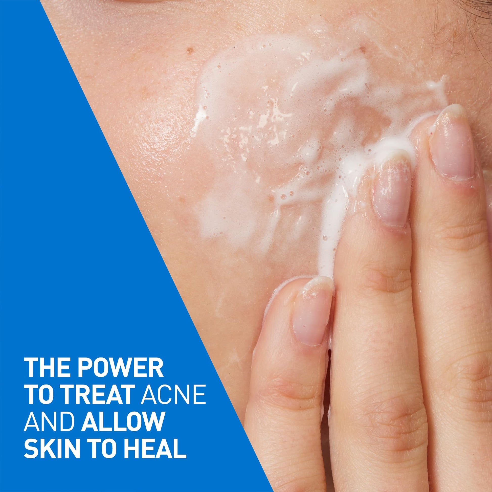 CeraVe 4% Benzoyl Peroxide Acne Treatment Foaming Cleanser Face & Body Wash, with Hyaluronic Acid and Niacinamide. Helps Clear Acne Pimples and prevent breakouts. Gentle Gel, Fragrance-Free, 150ML