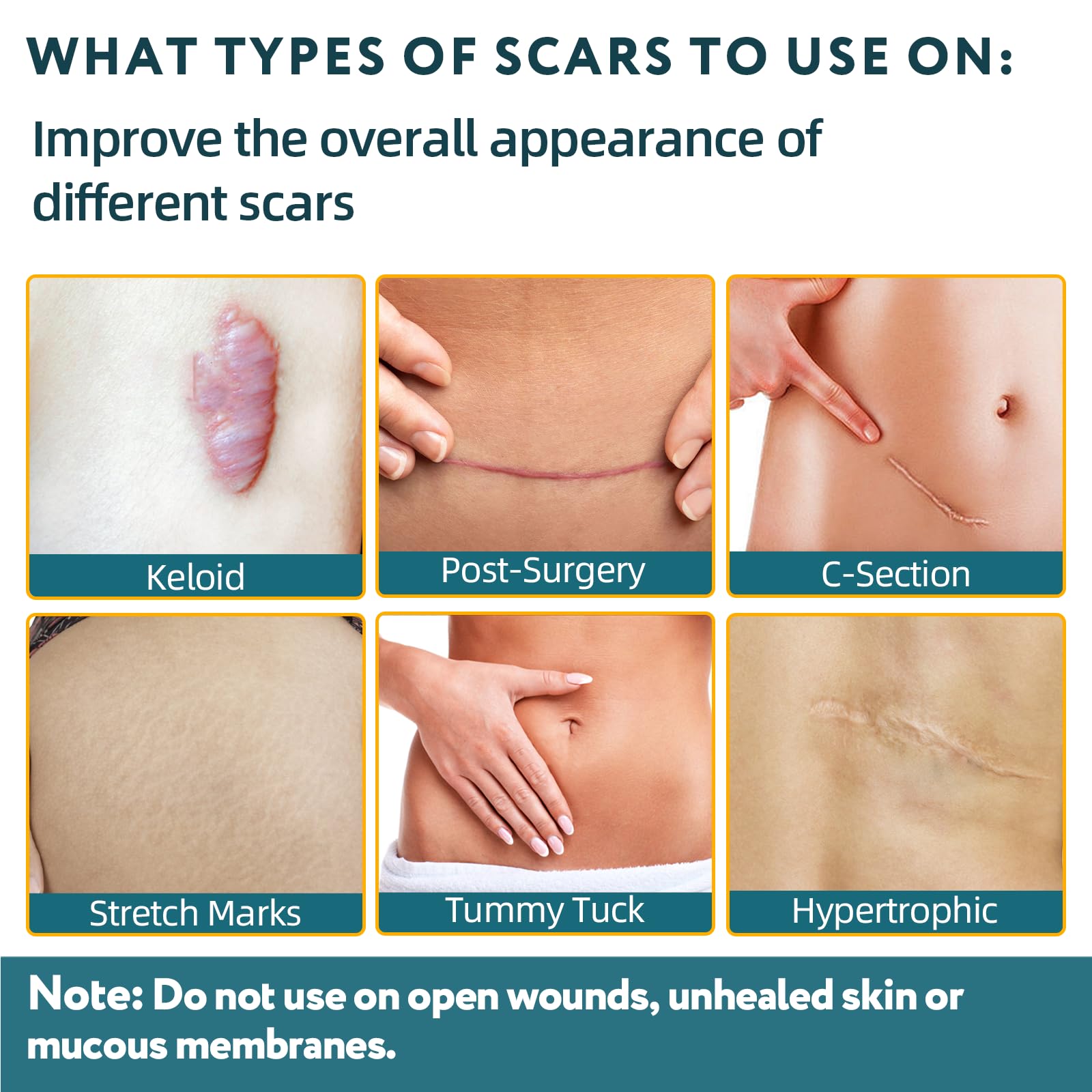 Silicone Scar Sheets, Silicone Scar Tape for Surgical Scars - 60" x 1.6" Roll - 1.5M, Medical Grade Reusable Scar Removal for Keloid, C-Section, and Tummy Tuck - Available at All In One Marketplace Canada