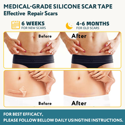 Silicone Scar Sheets, Silicone Scar Tape for Surgical Scars - 60" x 1.6" Roll - 1.5M, Medical Grade Reusable Scar Removal for Keloid, C-Section, and Tummy Tuck - Available at All In One Marketplace Canada