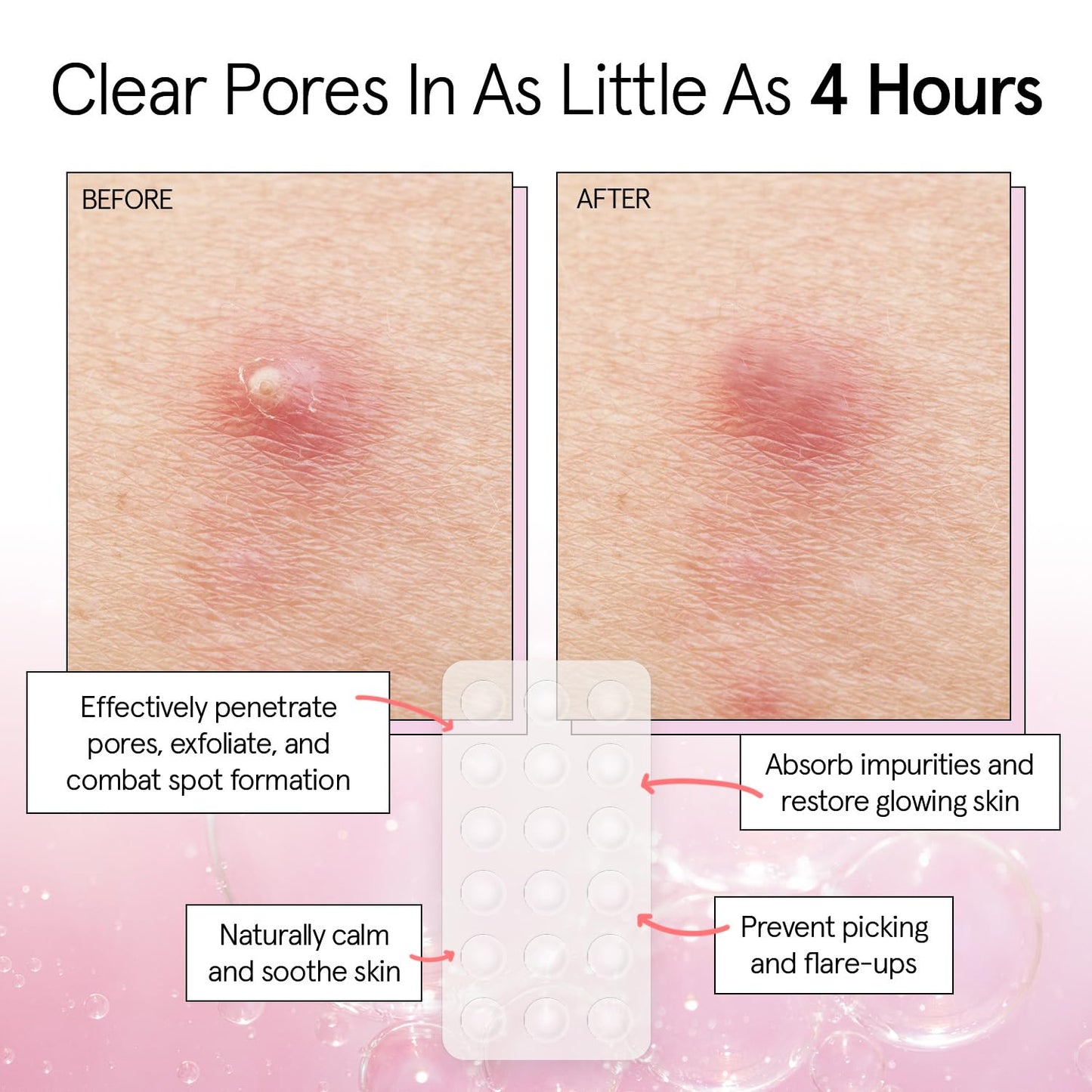 grace & stella Award Winning Invisible Skin Rescue Covers with Hydrocolloid (Round, 36 Count) - With Salicylic Acid and Tea Tree for Absorbing Impurities - Dermatologist Tested Skin Care, Cruelty Free, Vegan