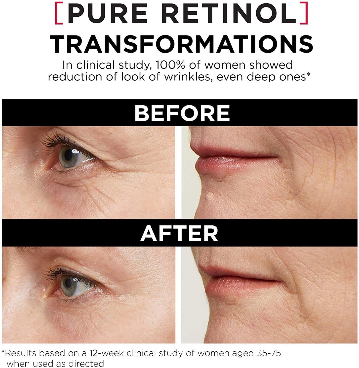 L'Oreal Paris 0.3% Pure Retinol Serum for Face, Night Serum Visibly Reduces the Look of Deep Wrinkles & Smoothes Texture, Revitalift Derm Intensives, 30ml - Available at All In One Marketplace Canada