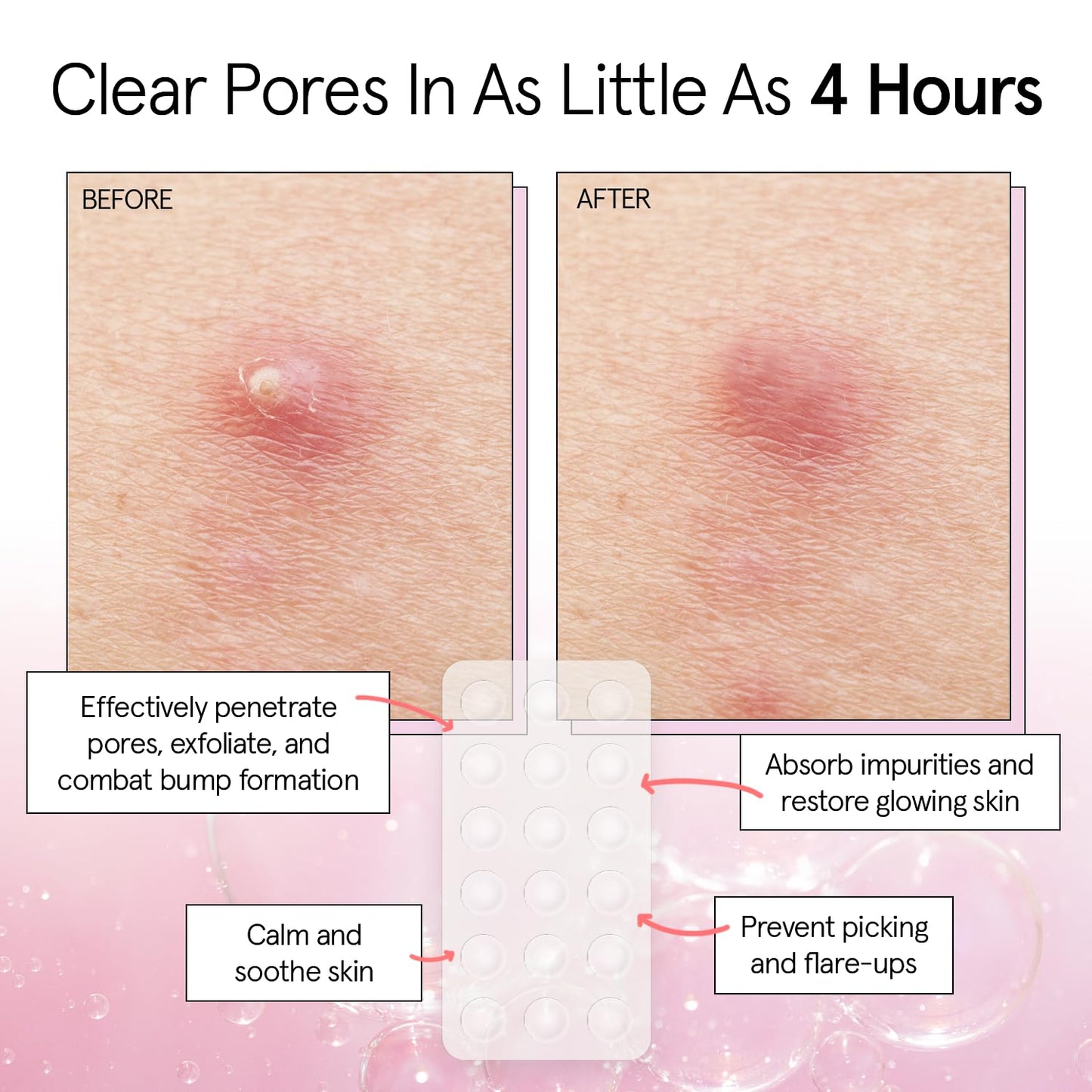 grace & stella Award Winning Invisible Spot Covers with Hydrocolloid (Round, 72 Count) - Spot Covers with Salicylic Acid and Tea Tree for Absorbing Impurities - Dermatologist Tested Skin Care, Cruelty Free, Vegan