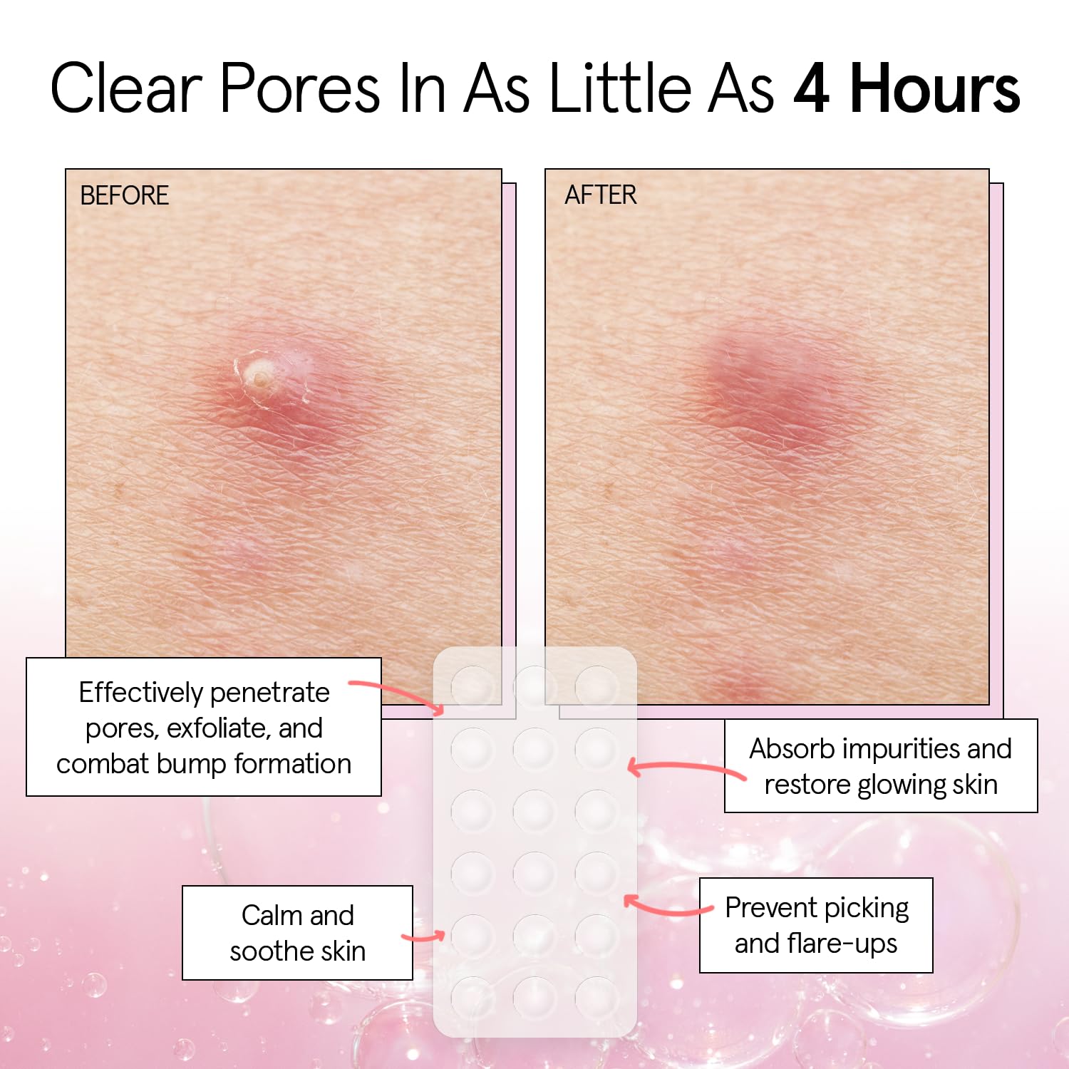 grace & stella Award Winning Invisible Spot Covers with Hydrocolloid (Round, 72 Count) - Spot Covers with Salicylic Acid and Tea Tree for Absorbing Impurities - Dermatologist Tested Skin Care, Cruelty Free, Vegan