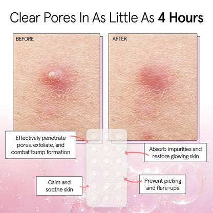 grace & stella Award Winning Invisible Spot Covers with Hydrocolloid (Round, 72 Count) - Spot Covers with Salicylic Acid and Tea Tree for Absorbing Impurities - Dermatologist Tested Skin Care, Cruelty Free, Vegan