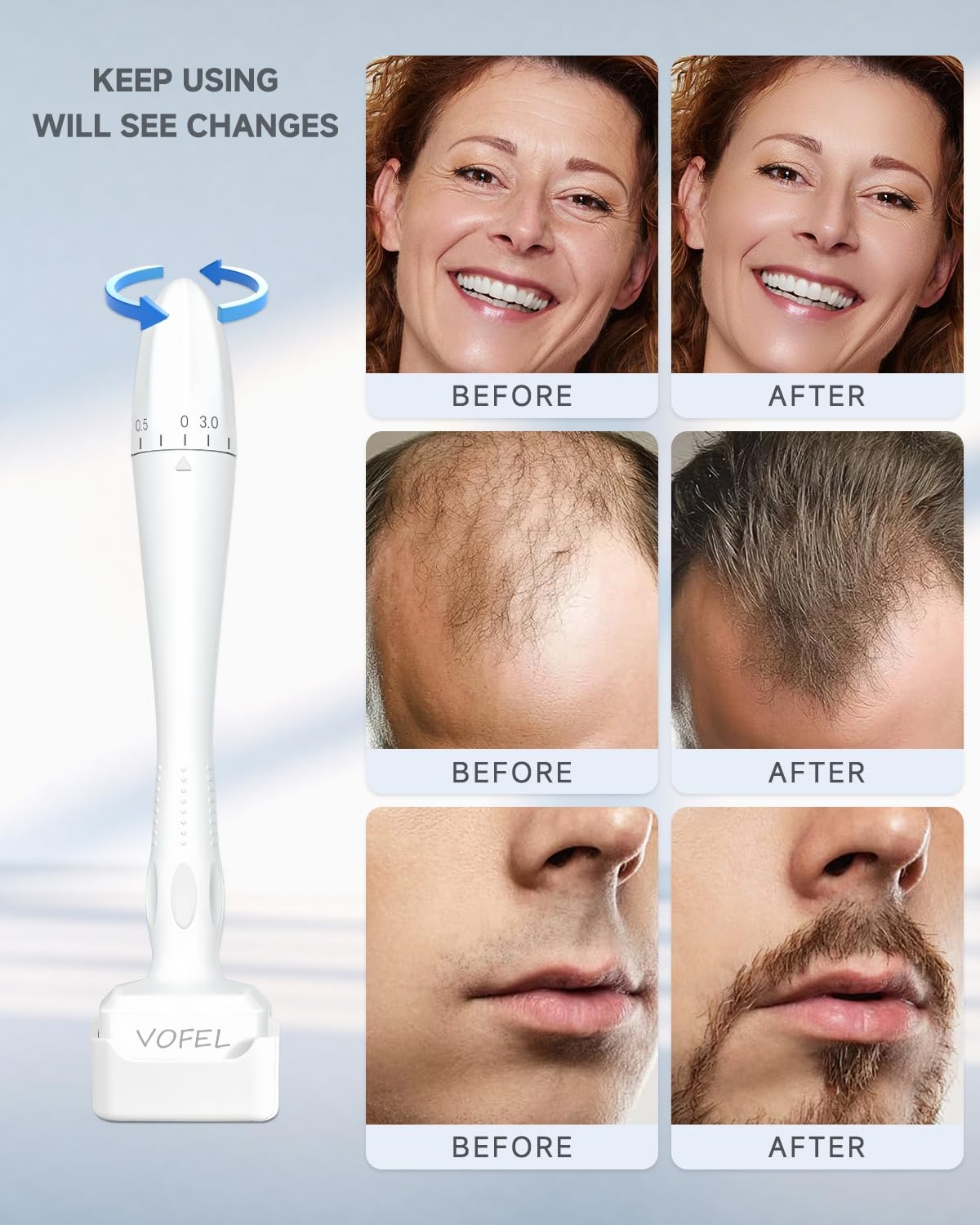 VOFEL Derma Stamp for Hair Growth 140 Microneedling Stamp Adjustable Derma Roller for Face 0-3mm Dermal Roller - SR Home Use (1PC) - Available at All In One Marketplace Canada