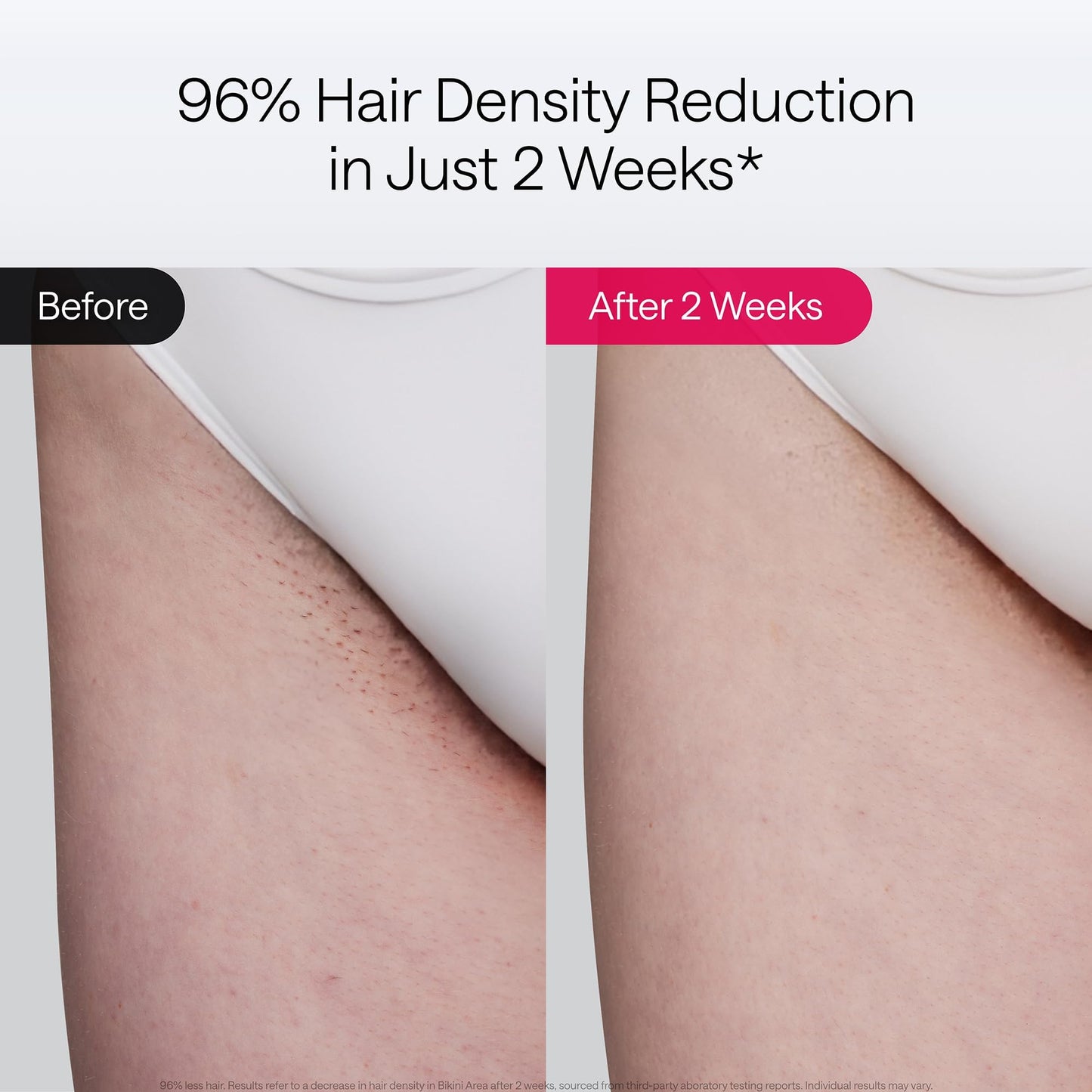 Ulike Laser Hair Removal, Air 10 IPL Device for Women and Men, 65°F Ice-Cooling Contact, Dual Lights, Skin Sensor & SHR Mode* for Nearly Painless, Effective & Long-Lasting Results from Home - Available at All In One Marketplace Canada
