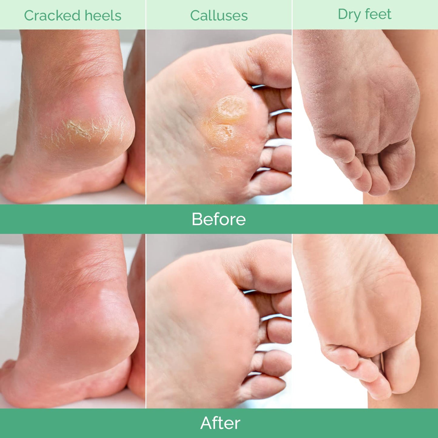 PLANTIFIQUE Foot Peel Mask Dermatologically Tested - 2 Pairs Peach Exfoliating Mask for Dry Cracked Feet - Masque Pied Peeling - Foot Care for Soft Baby Feet - Available at All In One Marketplace Canada