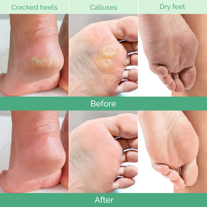 PLANTIFIQUE Foot Peel Mask Dermatologically Tested - 2 Pairs Peach Exfoliating Mask for Dry Cracked Feet - Masque Pied Peeling - Foot Care for Soft Baby Feet - Available at All In One Marketplace Canada