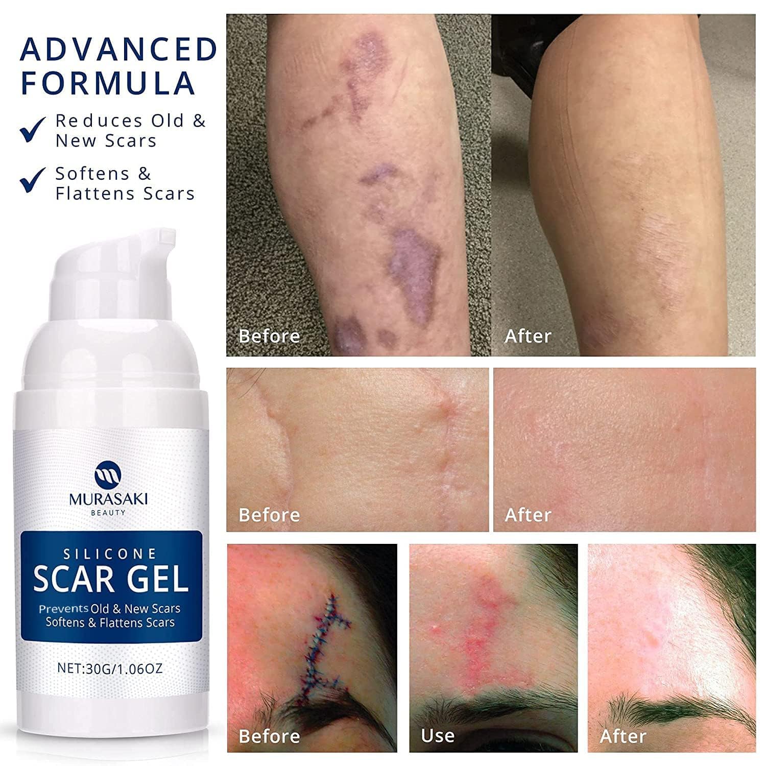 100% Silicone Scar Gel Scar Cream - Advanced Scar Gel for Old and New Scars - Available at All In One Marketplace Canada