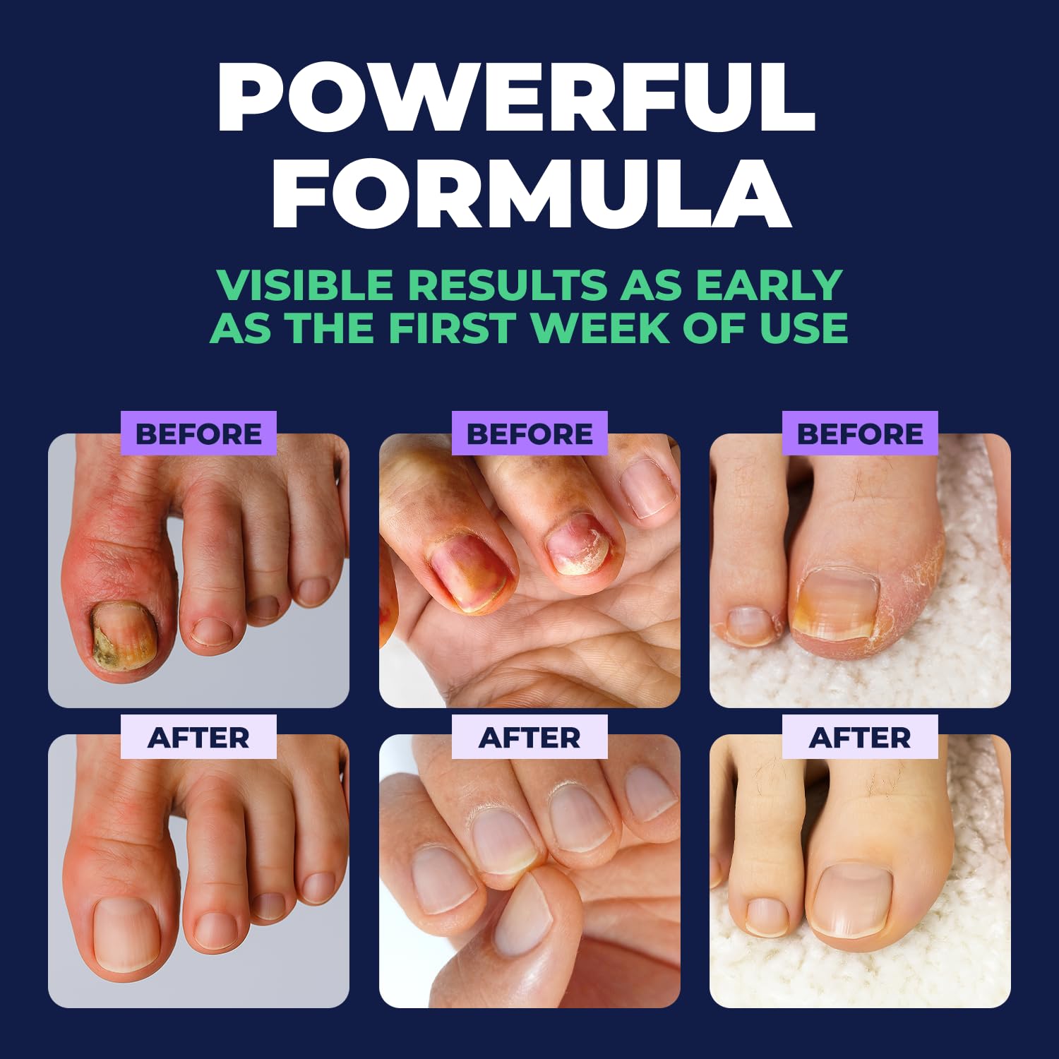Orivelle Toenail Care Pen - Extra Strength Toe Nail Remedy - Professional Nail Solution for Fingernail with Tea Tree Oil (Pack of 4)