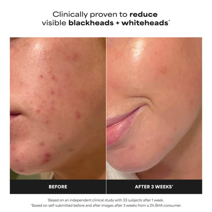 Paula's Choice SKIN PERFECTING 2% BHA Liquid Salicylic Acid Exfoliant, Daily Facial Exfoliator for Enlarged Pores, Wrinkles & Fine Lines, Fragrance-Free, Full Size - 118 ml