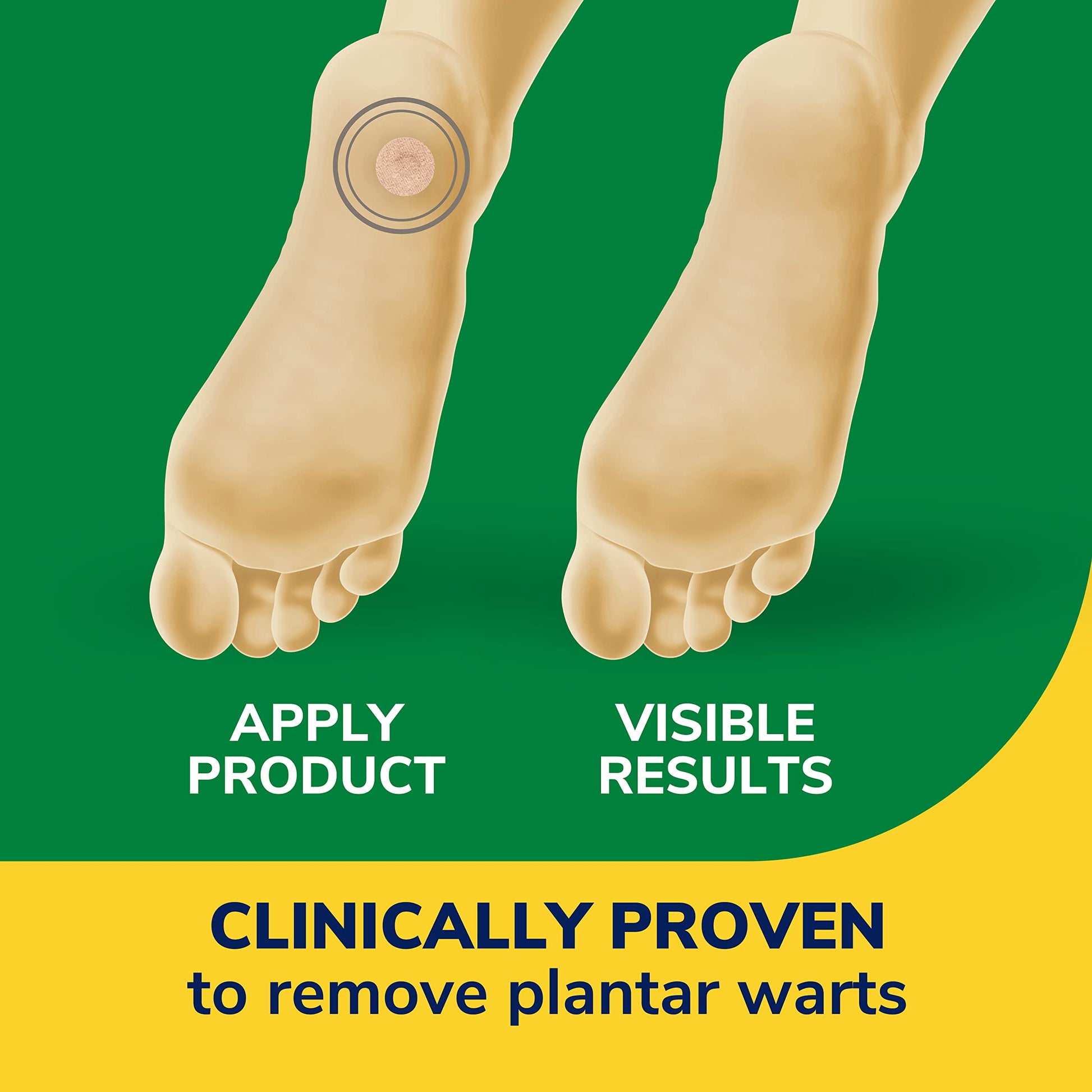 Dr. Scholl's Clear Away Wart Remover Plantar Wart,24 Count - Available at All In One Marketplace Canada