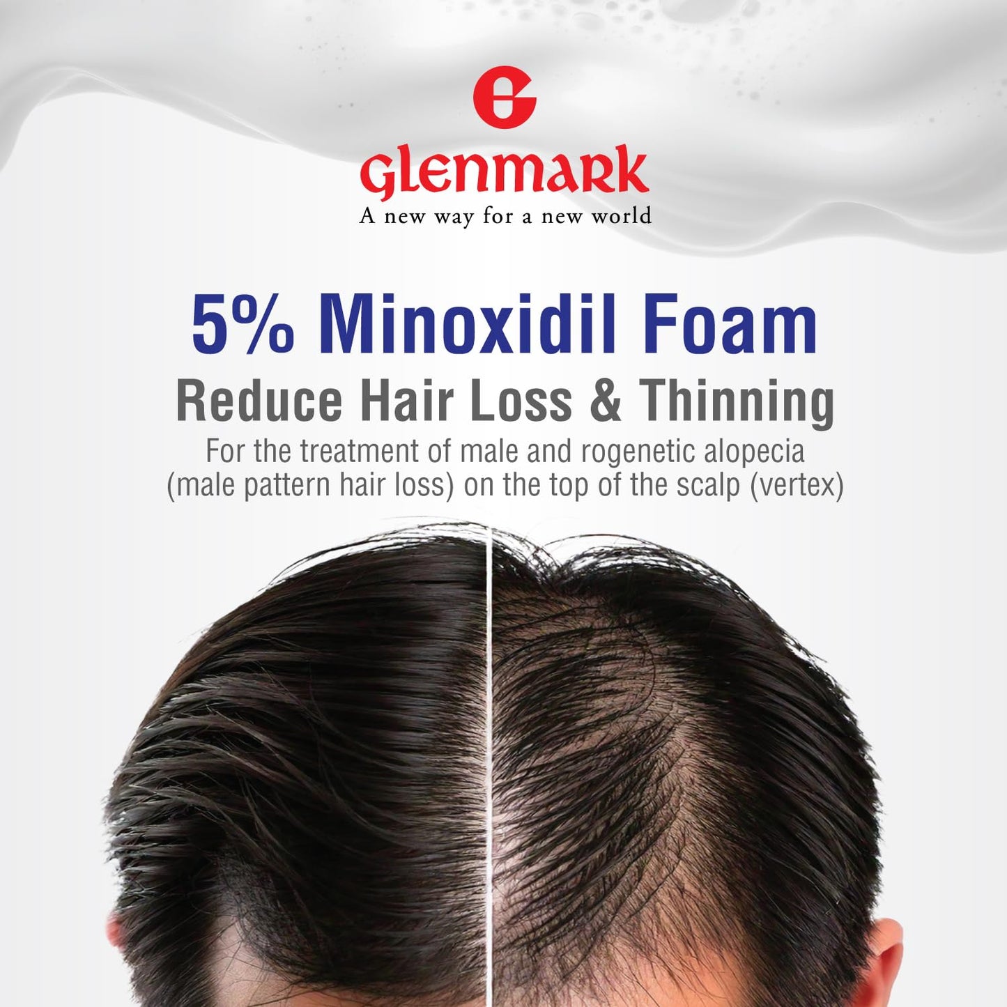 Glenmark | Minoxidil 5% Hair Regrowth Foam for Men, Aerosol Can, 1 Month Treatment (60 gr) – Mess-Free, Fast-Drying Formula for Thinning Hair & Hair Loss – Reactivates Follicles