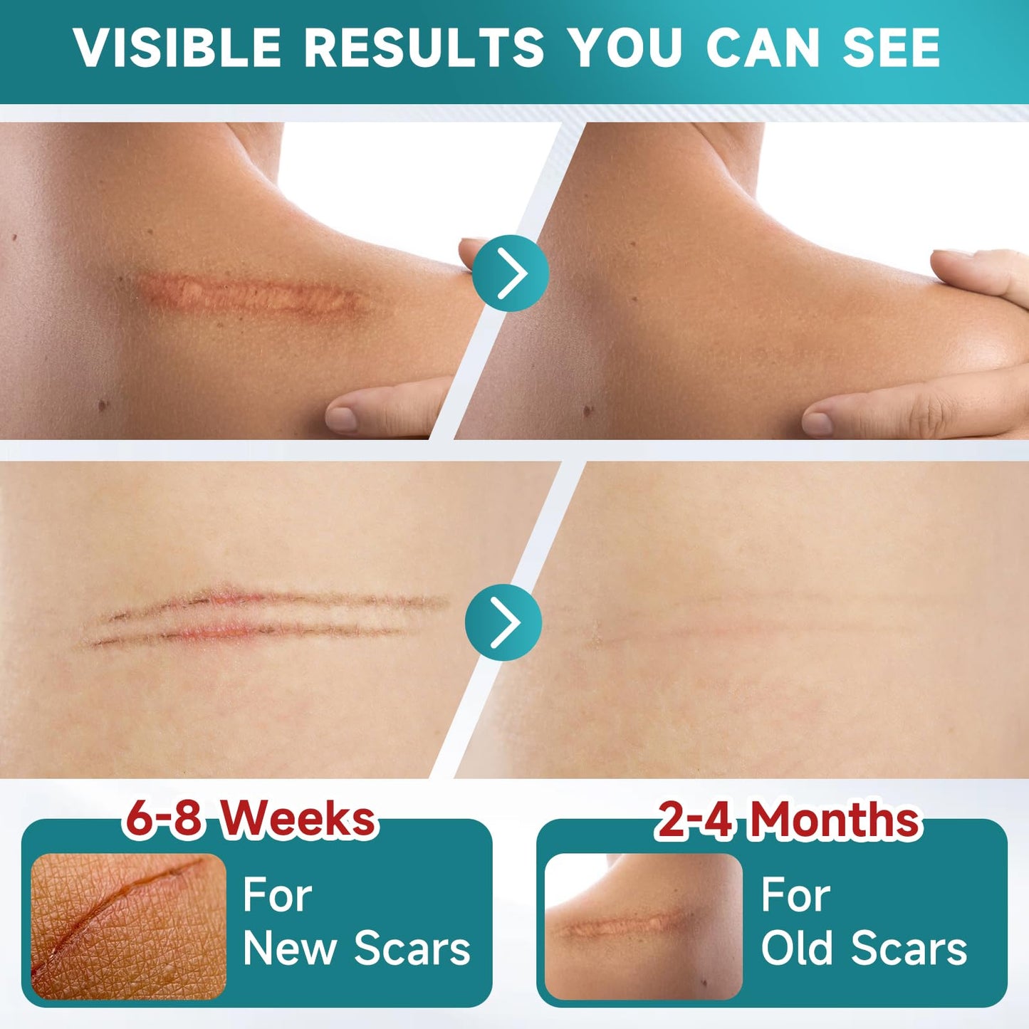 Pumkot Silicone Scar Sheets, Silicone Scar Tape(1.6” x 120” Roll-3M) - Available at All In One Marketplace Canada