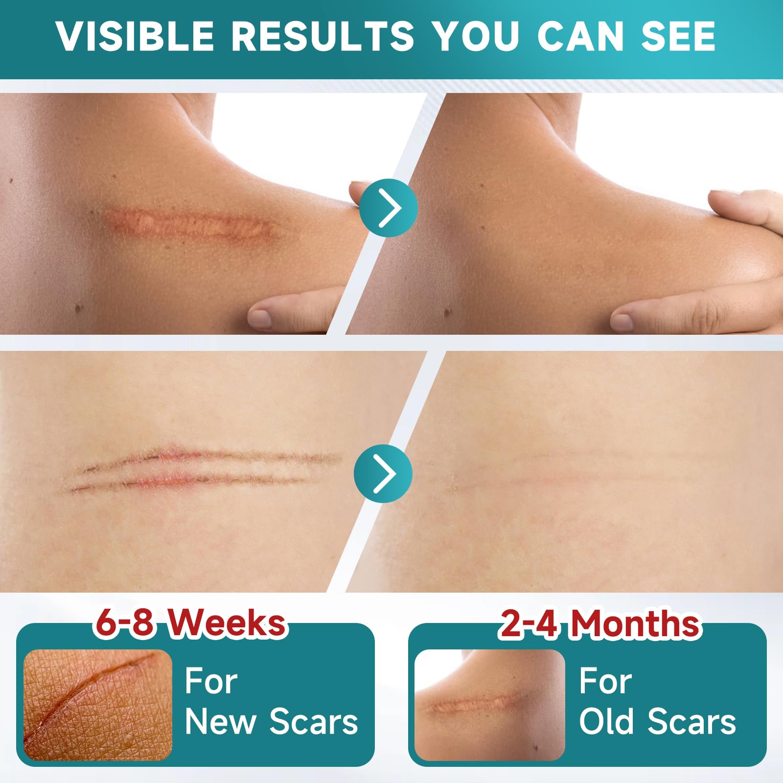Pumkot Silicone Scar Sheets, Silicone Scar Tape(1.6” x 120” Roll-3M) - Available at All In One Marketplace Canada