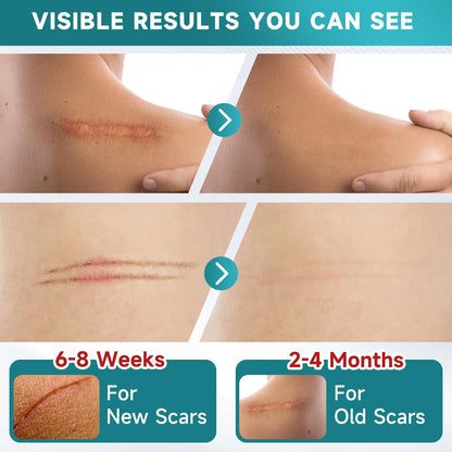 Pumkot Silicone Scar Sheets, Silicone Scar Tape(1.6” x 120” Roll-3M) - Available at All In One Marketplace Canada