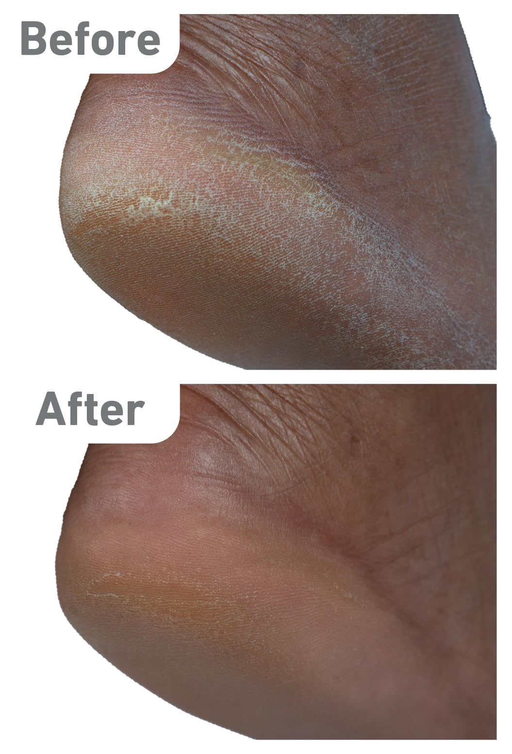 O'Keeffe's Healthy Feet Heel Balm Stick for Dry Cracked Feet & Heels O'Keeffe's