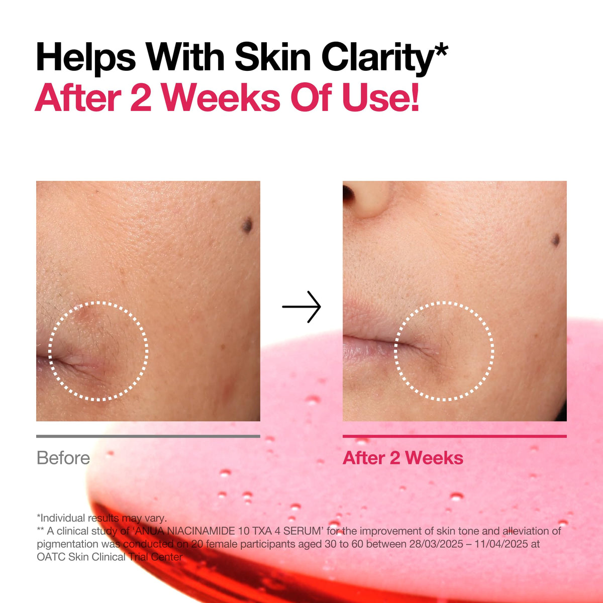 Miracle Korean Serum NIACINAMIDE 10% + TXA 4% DARK SPOT REMOVING SERUM 30mL - 14 days miracle A_N_U_A import