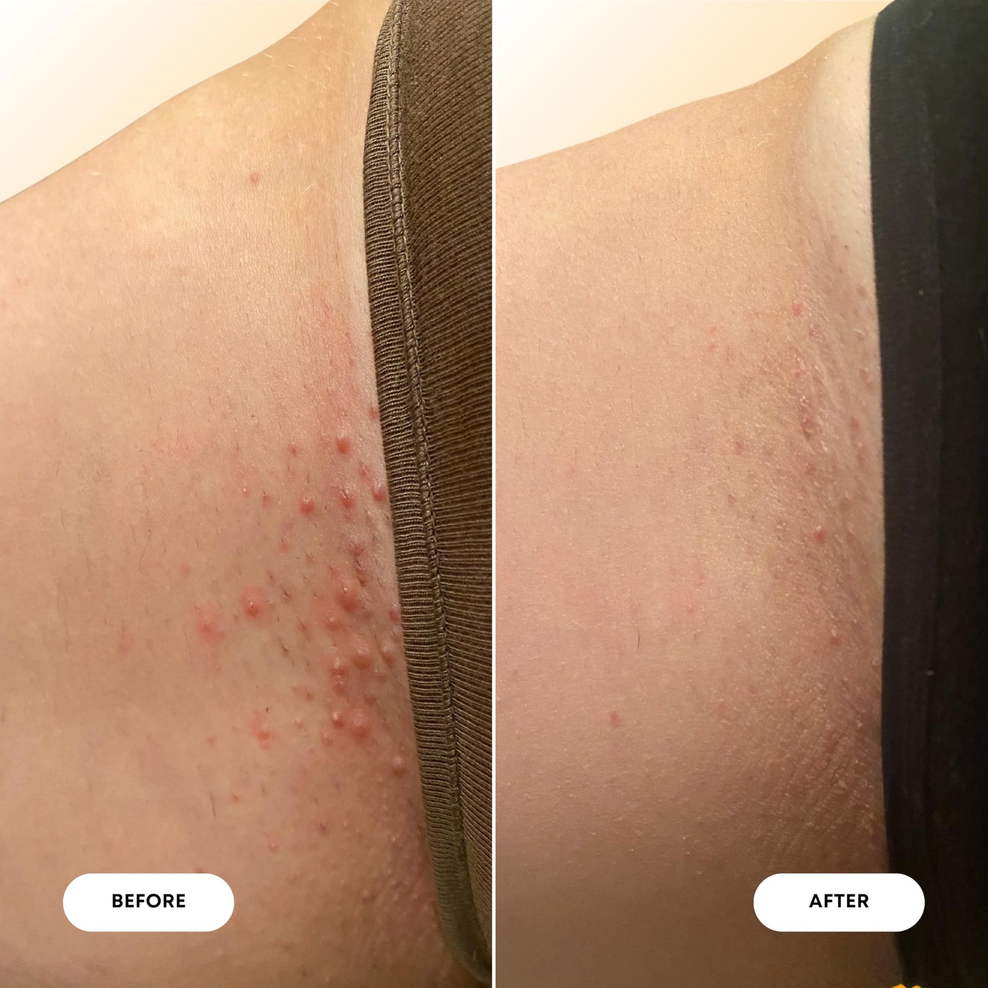 Bushbalm Ingrown Hair Oil - Helps Reduce, Repair Skin from Ingrown Hairs, Razor Bumps & Underarm Bumps - Soothe Skin from Post Shave Itchiness 30 ml - Vanilla Tangerine Oil - Formerly Sweet Escape
