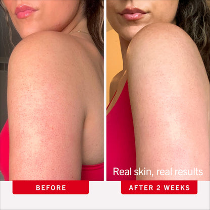 First Aid Beauty KP Bump Eraser Body Scrub Fresh Strawberry Scent, 10% AHA Keratosis Pilaris Exfoliator - Glycolic & Lactic Acid with Pumice, Treatment for Strawberry Legs, Razor Bumps & Rough Bumpy Skin, 8 oz First Aid Beauty