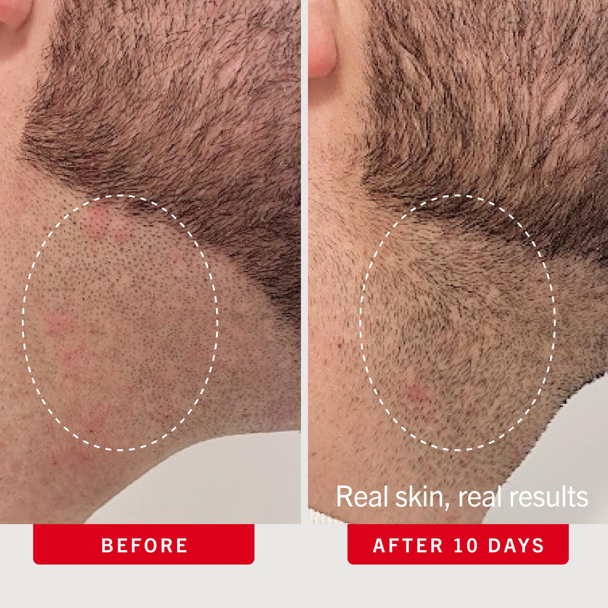 First Aid Beauty Ingrown Hair Pads, BHA + AHA Exfoliating Pads for Face and Body, Prevents Razor Bumps and Ingrown Hairs, Safe for Underarms, Bikini Area, Legs and Face, Sensitive Skin Safe, 28 ct