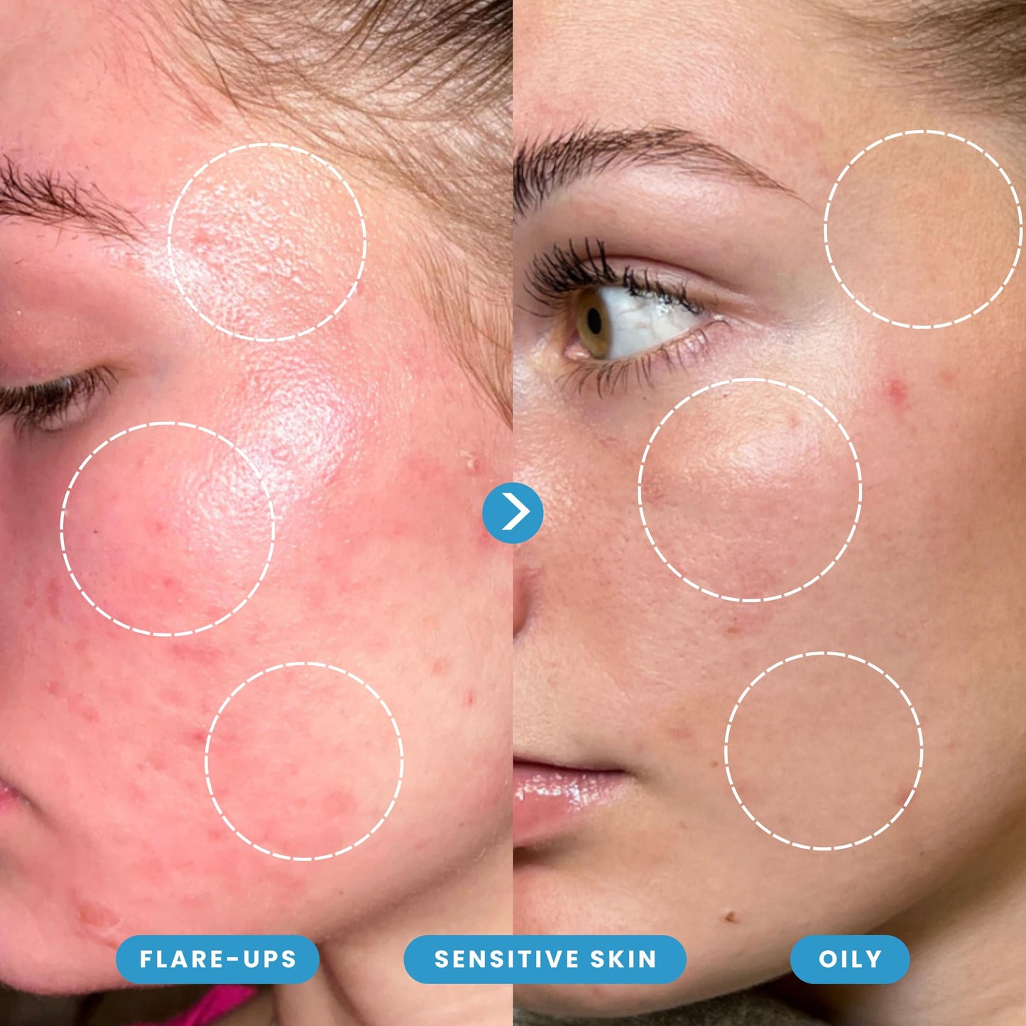 Hypochlorous Acid Spray – Dermatologist Tested HOCl Facial Cleanser for Sensitive, Acne-Prone & Irritated Skin – Soothes Redness, Eczema, Rashes & Itching – Skin Repair Spray, 200 mL - Honeydew Labs - Available at All In One Marketplace Canada
