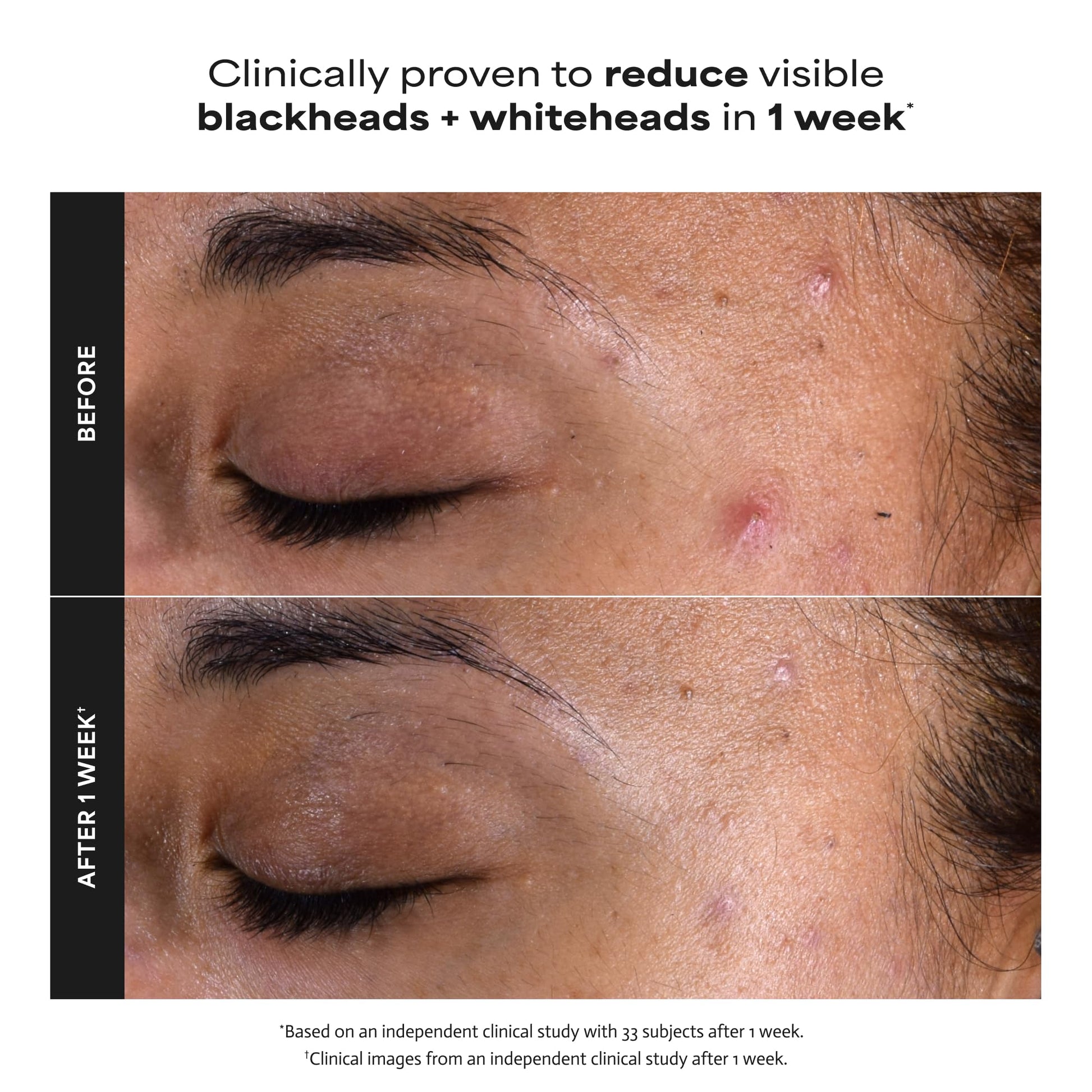 Paula's Choice SKIN PERFECTING 2% BHA Liquid Salicylic Acid Exfoliant, Daily Facial Exfoliator for Enlarged Pores, Wrinkles & Fine Lines, Fragrance-Free, Full Size - 118 ml