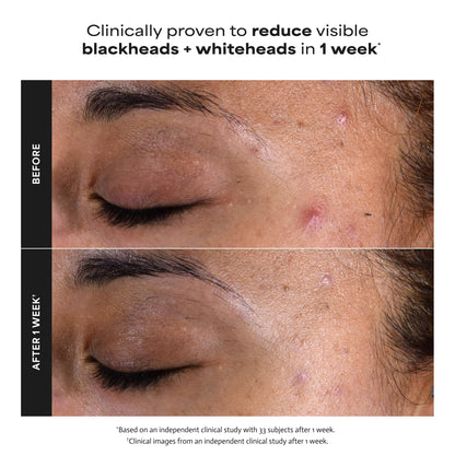 Paula's Choice SKIN PERFECTING 2% BHA Liquid Salicylic Acid Exfoliant, Daily Facial Exfoliator for Enlarged Pores, Wrinkles & Fine Lines, Fragrance-Free, Full Size - 118 ml