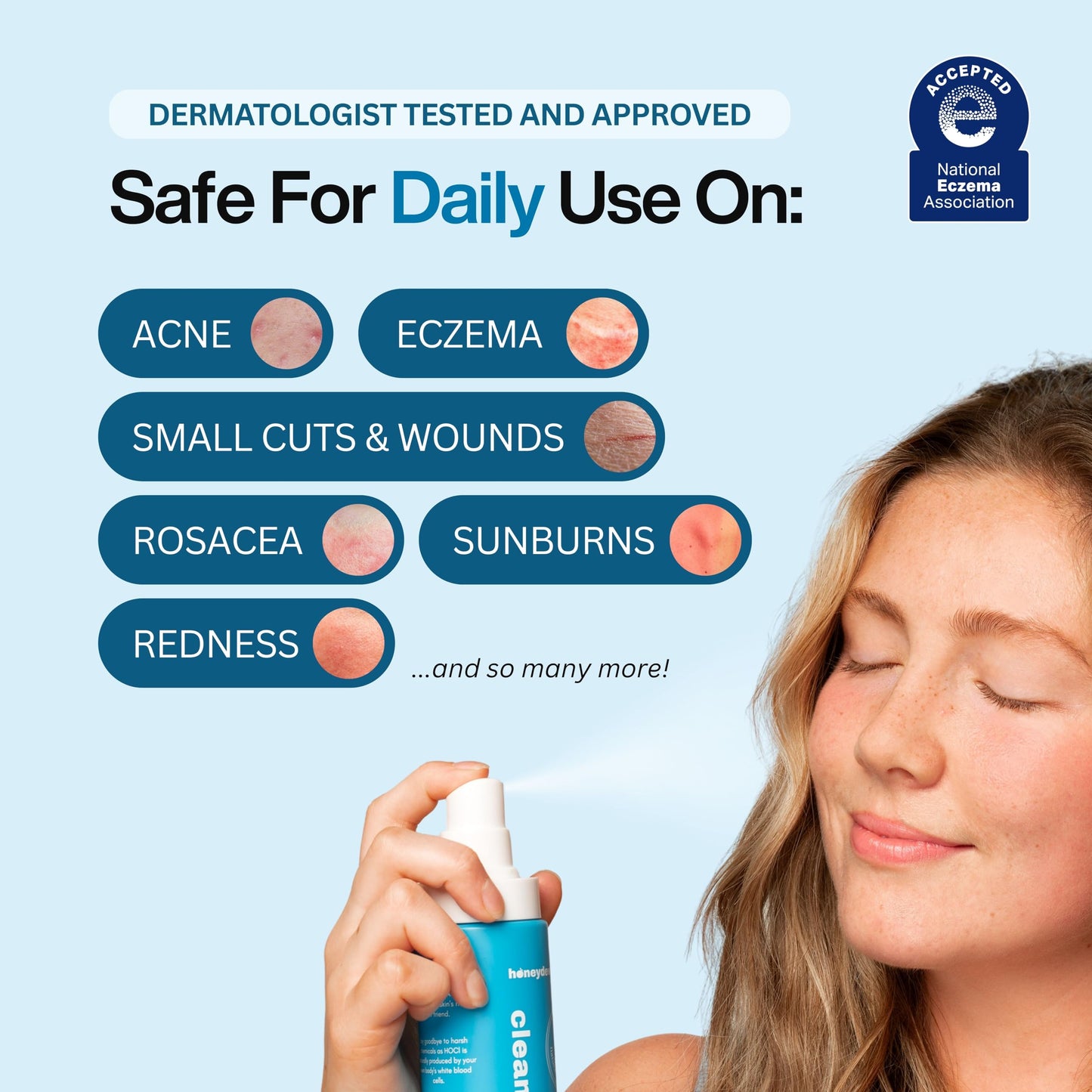 Hypochlorous Acid Spray – Dermatologist Tested HOCl Facial Cleanser for Sensitive, Acne-Prone & Irritated Skin – Soothes Redness, Eczema, Rashes & Itching – Skin Repair Spray, 200 mL - Honeydew Labs - Available at All In One Marketplace Canada