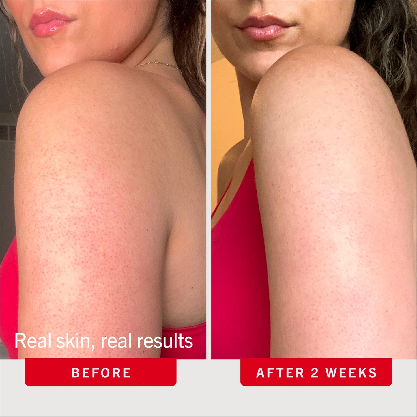 First Aid Beauty KP Bump Eraser Body Scrub, 10% AHA Keratosis Pilaris Exfoliator - Glycolic & Lactic Acid with Pumice, Treatment for Strawberry Legs, Razor Bumps & Rough Bumpy Skin, Safe for Sensitive Skin, 10 oz, Unscented First Aid Beauty