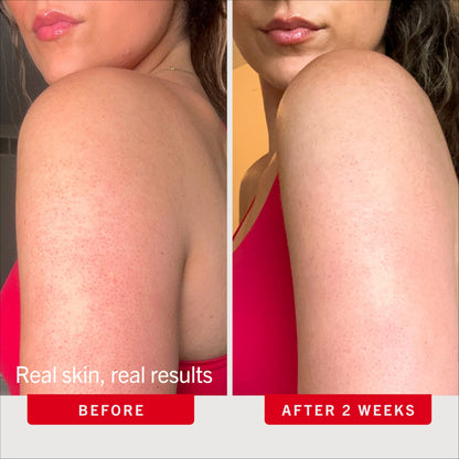 First Aid Beauty KP Bump Eraser Body Scrub, 10% AHA Keratosis Pilaris Exfoliator - Glycolic & Lactic Acid with Pumice, Treatment for Strawberry Legs, Razor Bumps & Rough Bumpy Skin, Safe for Sensitive Skin, 10 oz, Unscented First Aid Beauty