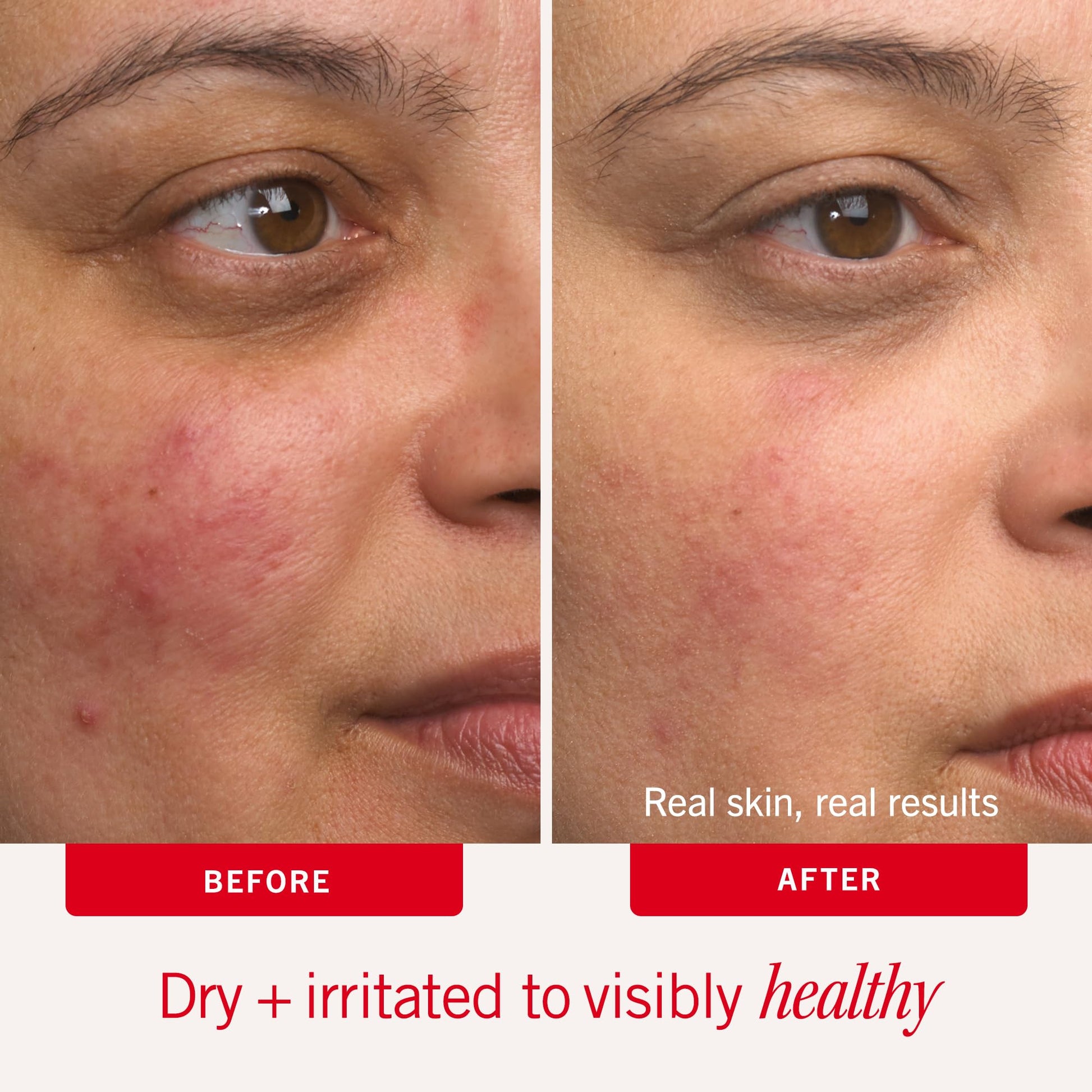 First Aid Beauty - Ultra Repair Cream - Intense Hydration Face & Body Moisturizer - Whipped Colloidal Oatmeal Clinically Proven to Strengthen Skin Barrier in 7 Days - Helps Relieve Eczema, 6 oz First Aid Beauty
