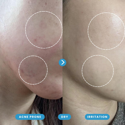 Hypochlorous Acid Spray – Dermatologist Tested HOCl Facial Cleanser for Sensitive, Acne-Prone & Irritated Skin – Soothes Redness, Eczema, Rashes & Itching – Skin Repair Spray, 200 mL - Honeydew Labs - Available at All In One Marketplace Canada