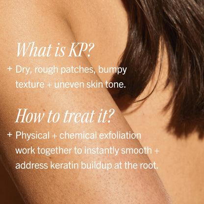 First Aid Beauty KP Bump Eraser Body Scrub Fresh Strawberry Scent, 10% AHA Keratosis Pilaris Exfoliator - Glycolic & Lactic Acid with Pumice, Treatment for Strawberry Legs, Razor Bumps & Rough Bumpy Skin, 8 oz First Aid Beauty